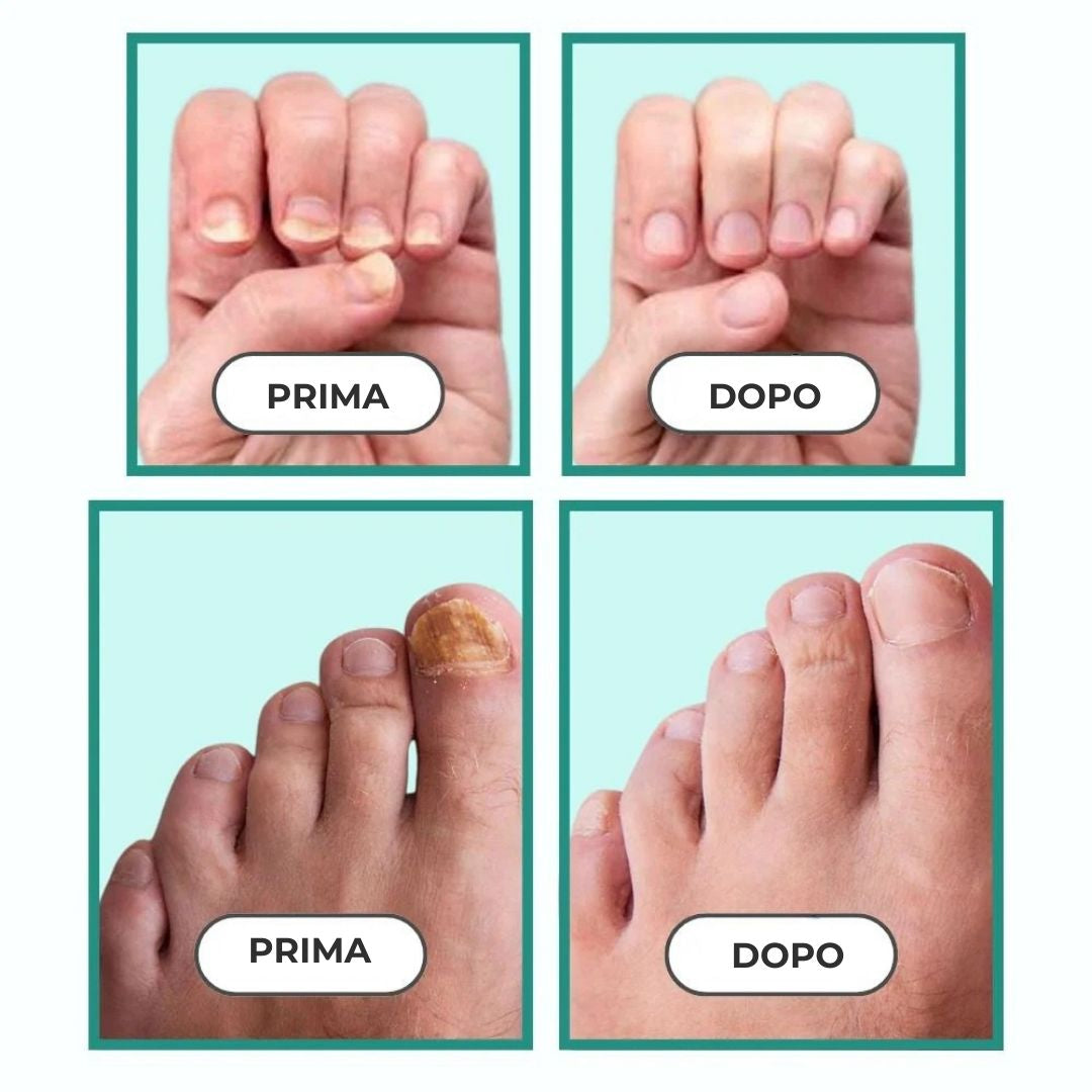 Dispositivo per il trattamento delle unghie incarnite e deformate