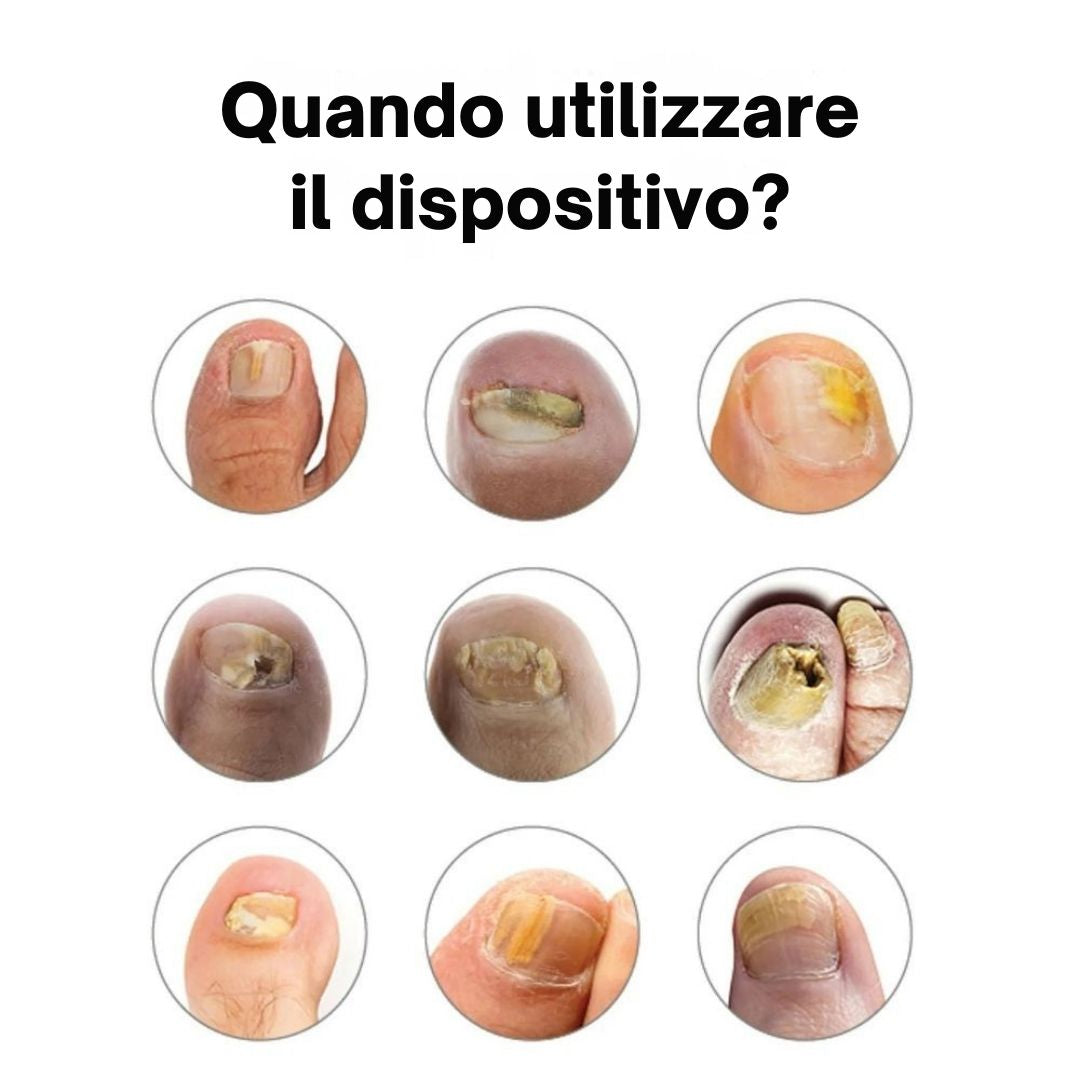 Dispositivo per il trattamento delle unghie incarnite e deformate